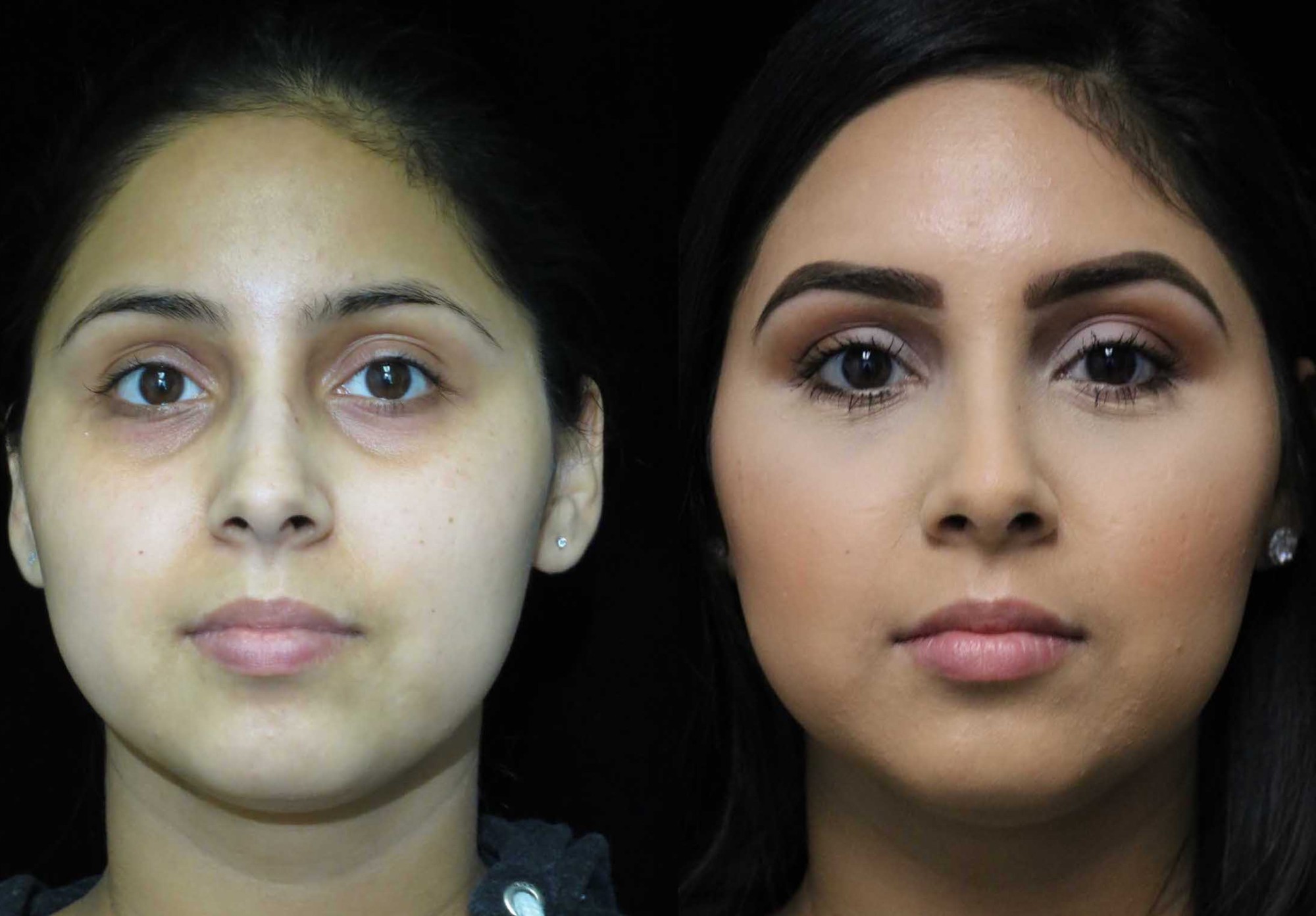 nose job before and after illustration of a woman with wide nasal bones