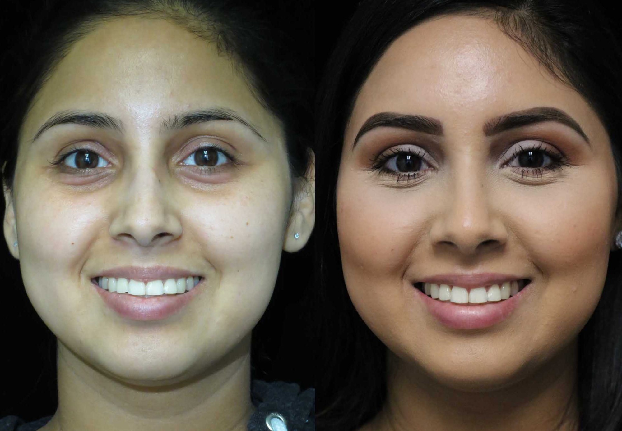 nose job before and after illustration of a woman with wide nasal bones