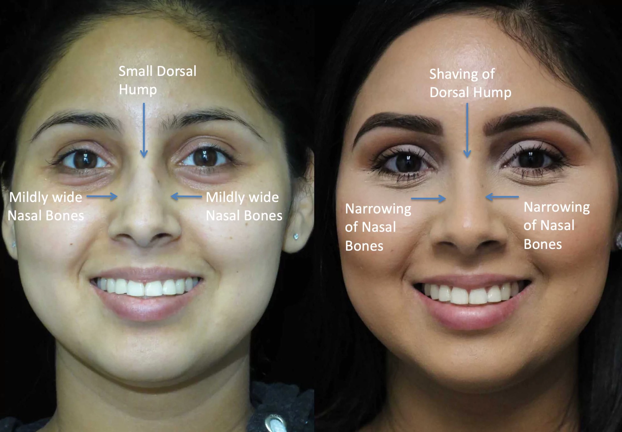 nose job before and after illustration of a woman with wide nasal bones