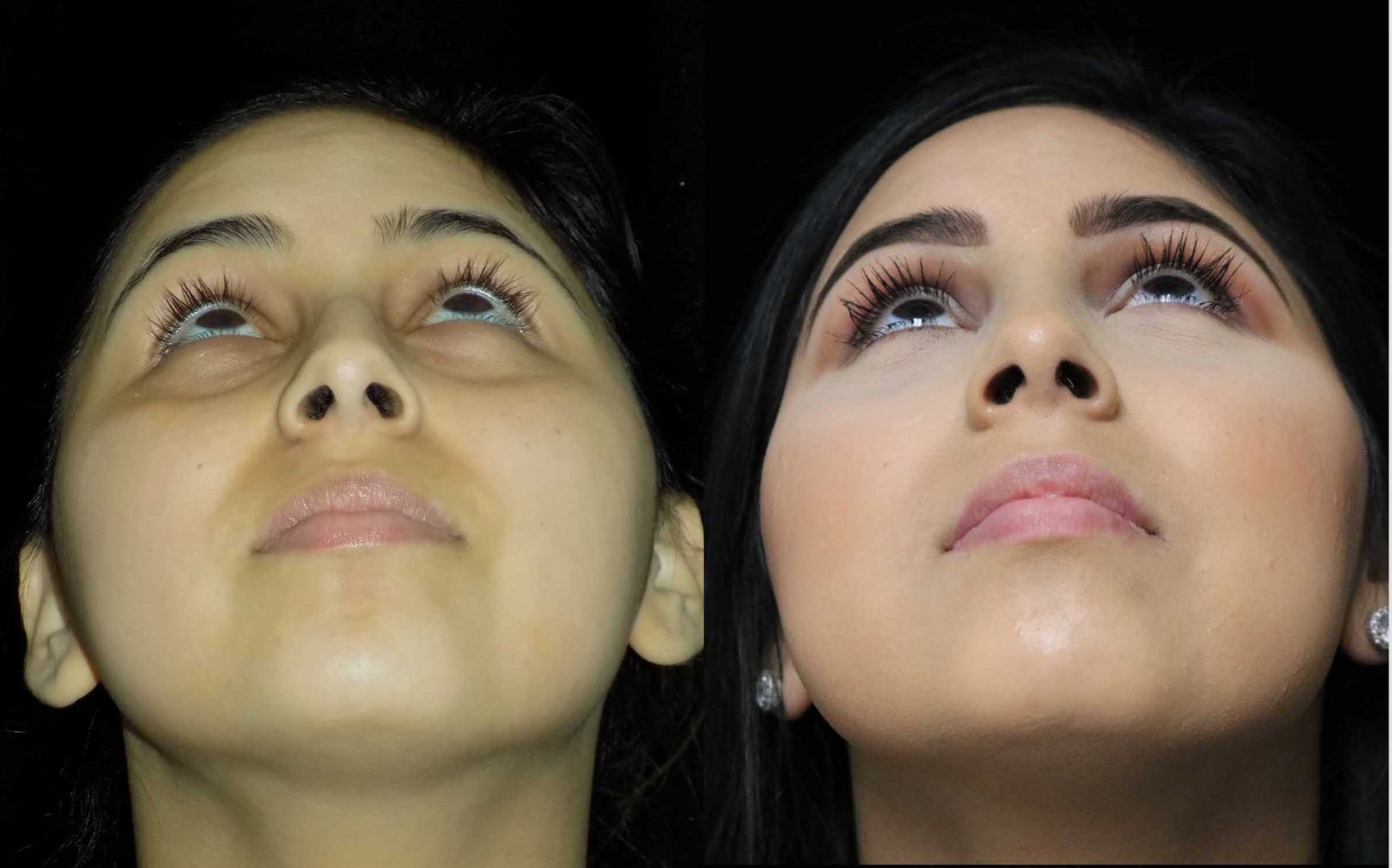 nose job before and after illustration of a woman with wide nasal bones