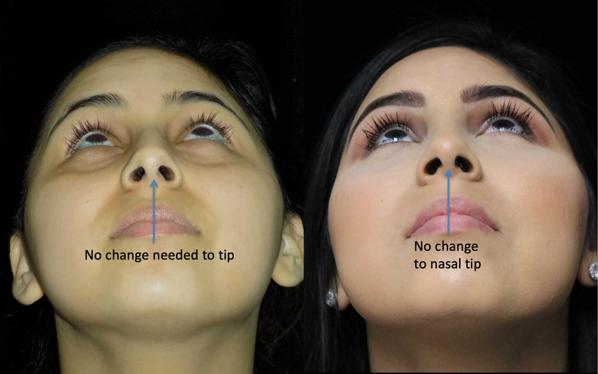 nose job before and after illustration of a woman with wide nasal bones