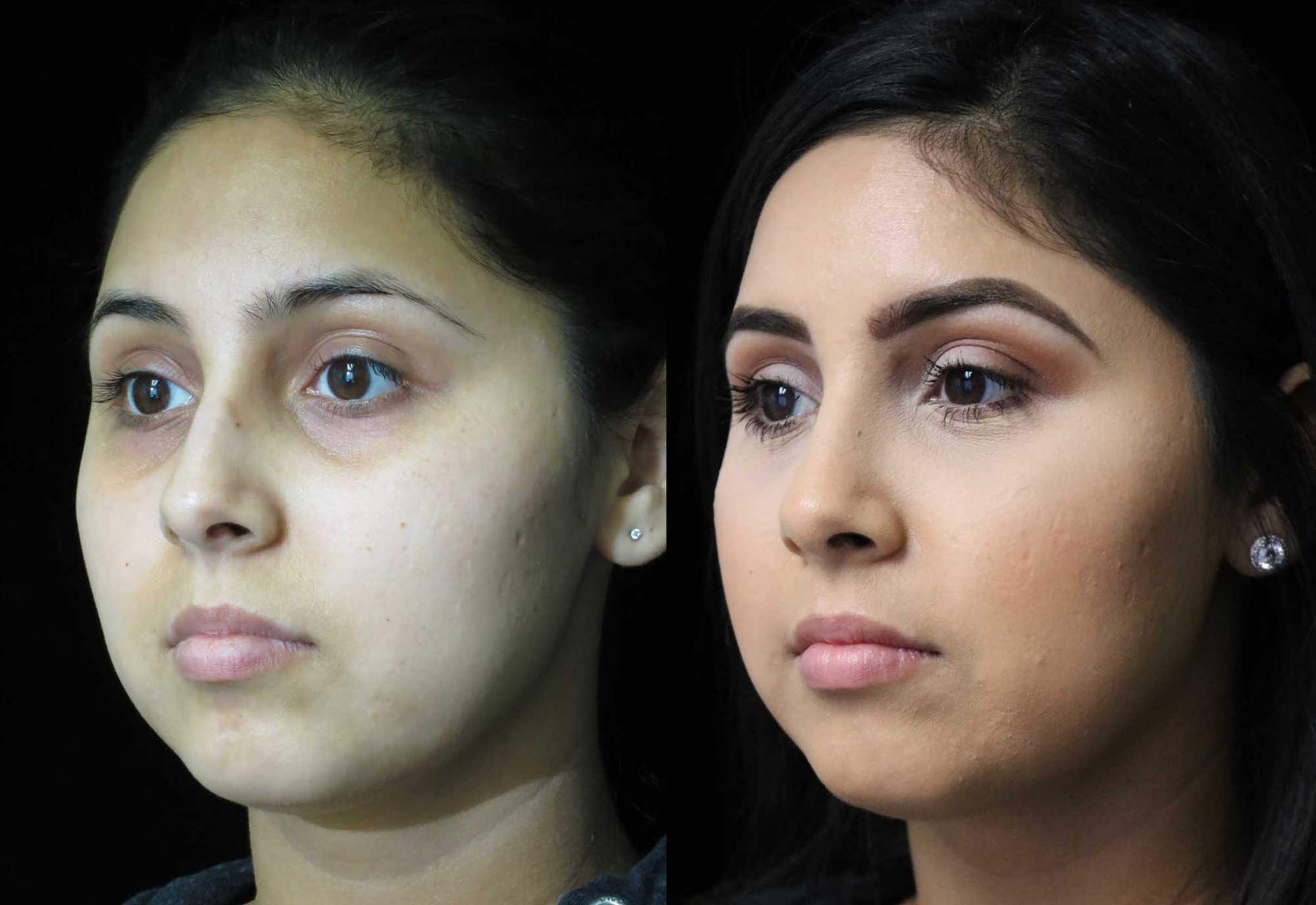 nose job before and after illustration of a woman with wide nasal bones