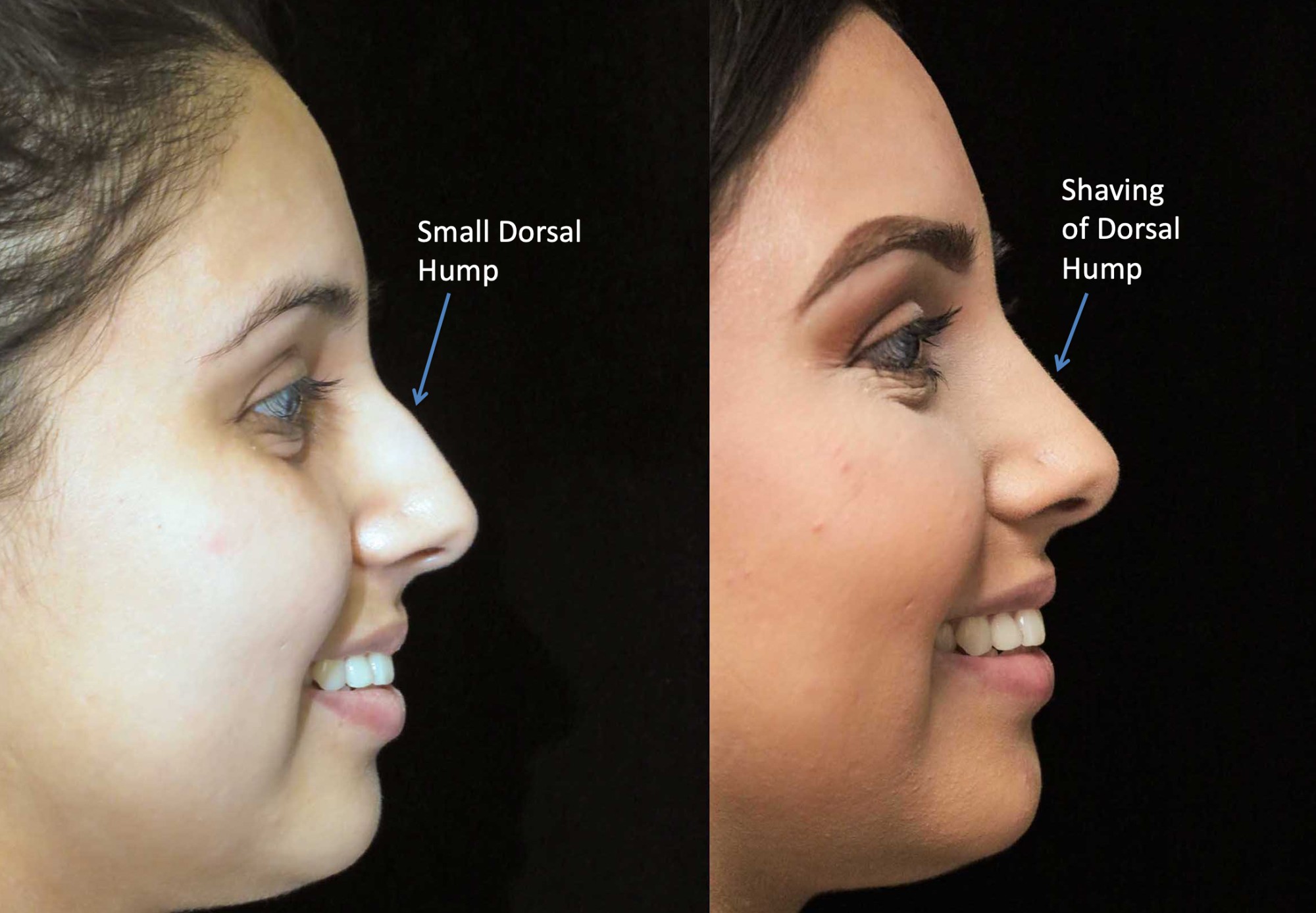 nose job before and after illustration of a woman with wide nasal bones