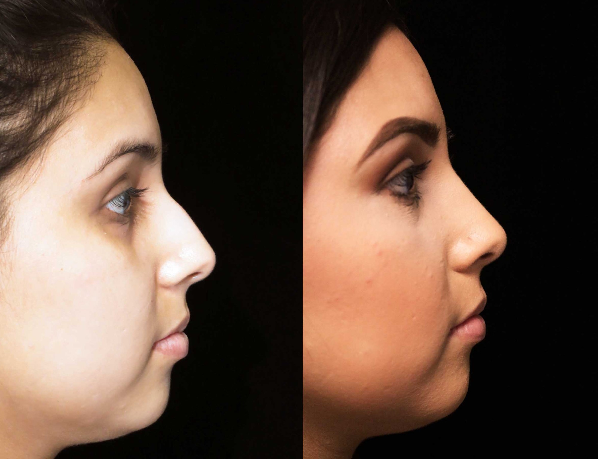 nose job before and after illustration of a woman with wide nasal bones