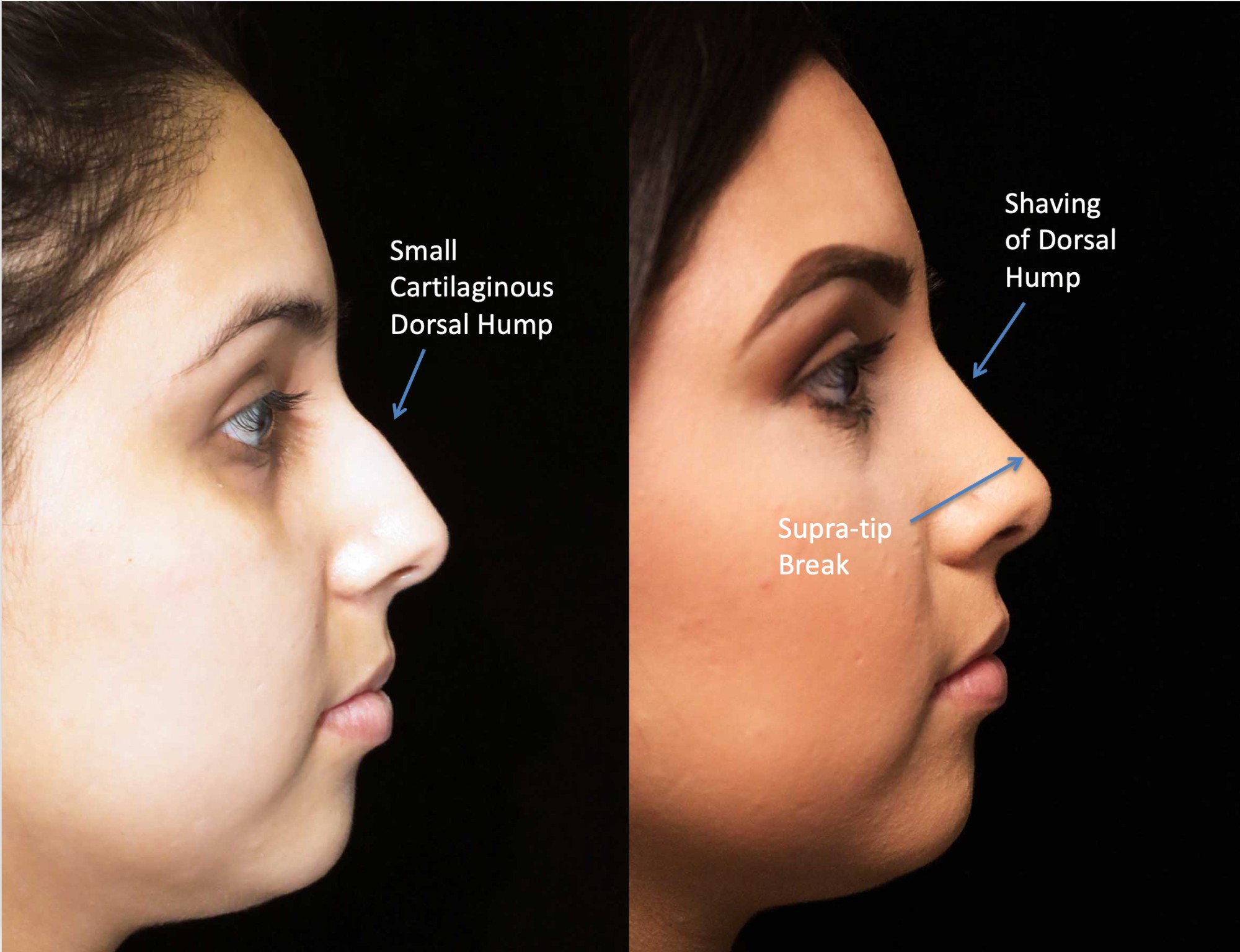 nose job before and after illustration of a woman with wide nasal bones
