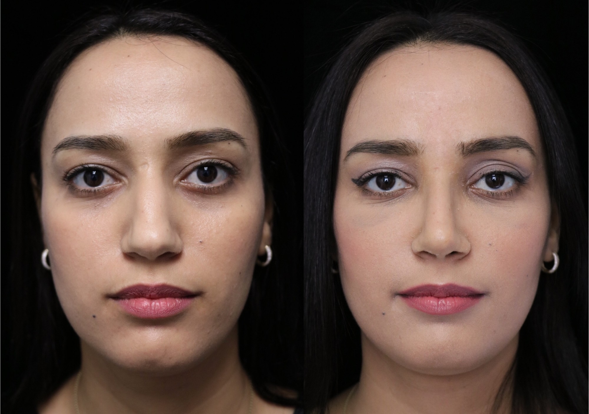 closed rhinoplasty before and after illustration of a woman with small dorsal hump