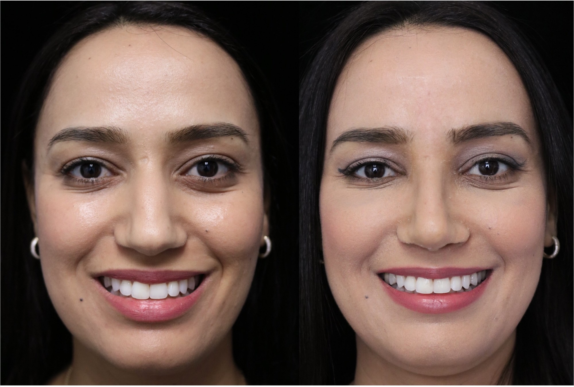 closed rhinoplasty before and after illustration of a woman with small dorsal hump