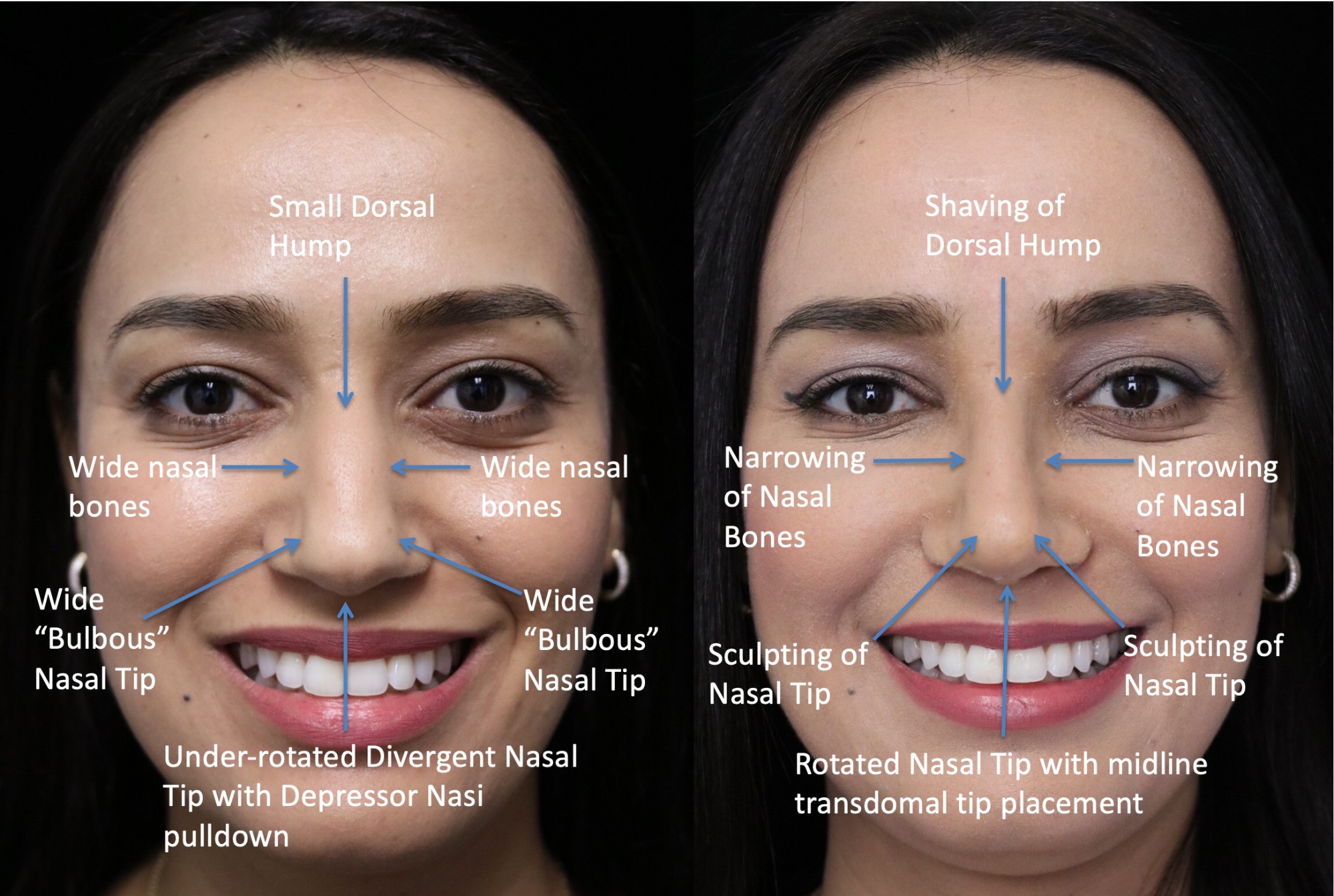 closed rhinoplasty before and after illustration of a woman with small dorsal hump