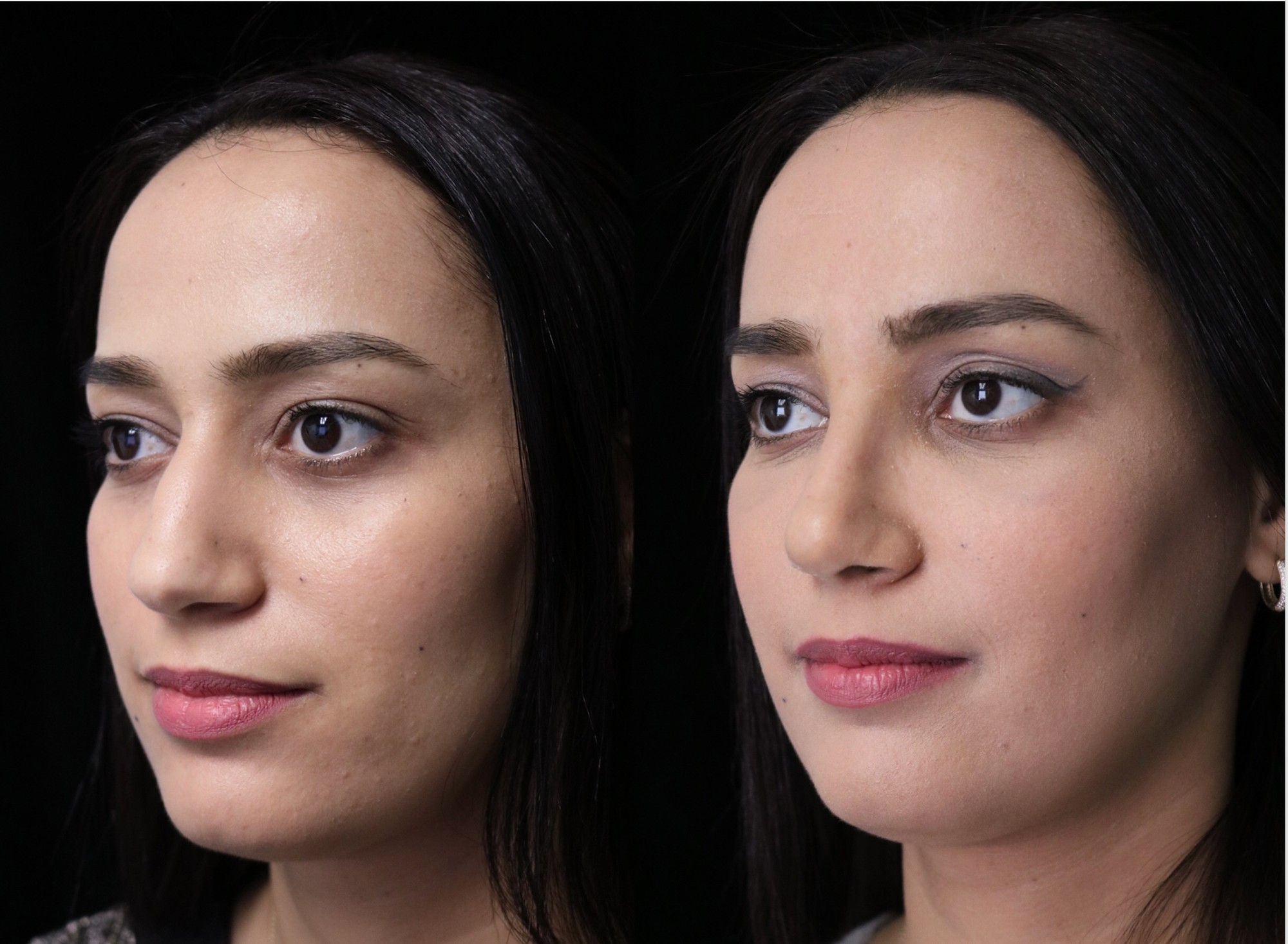 closed rhinoplasty before and after illustration of a woman with small dorsal hump