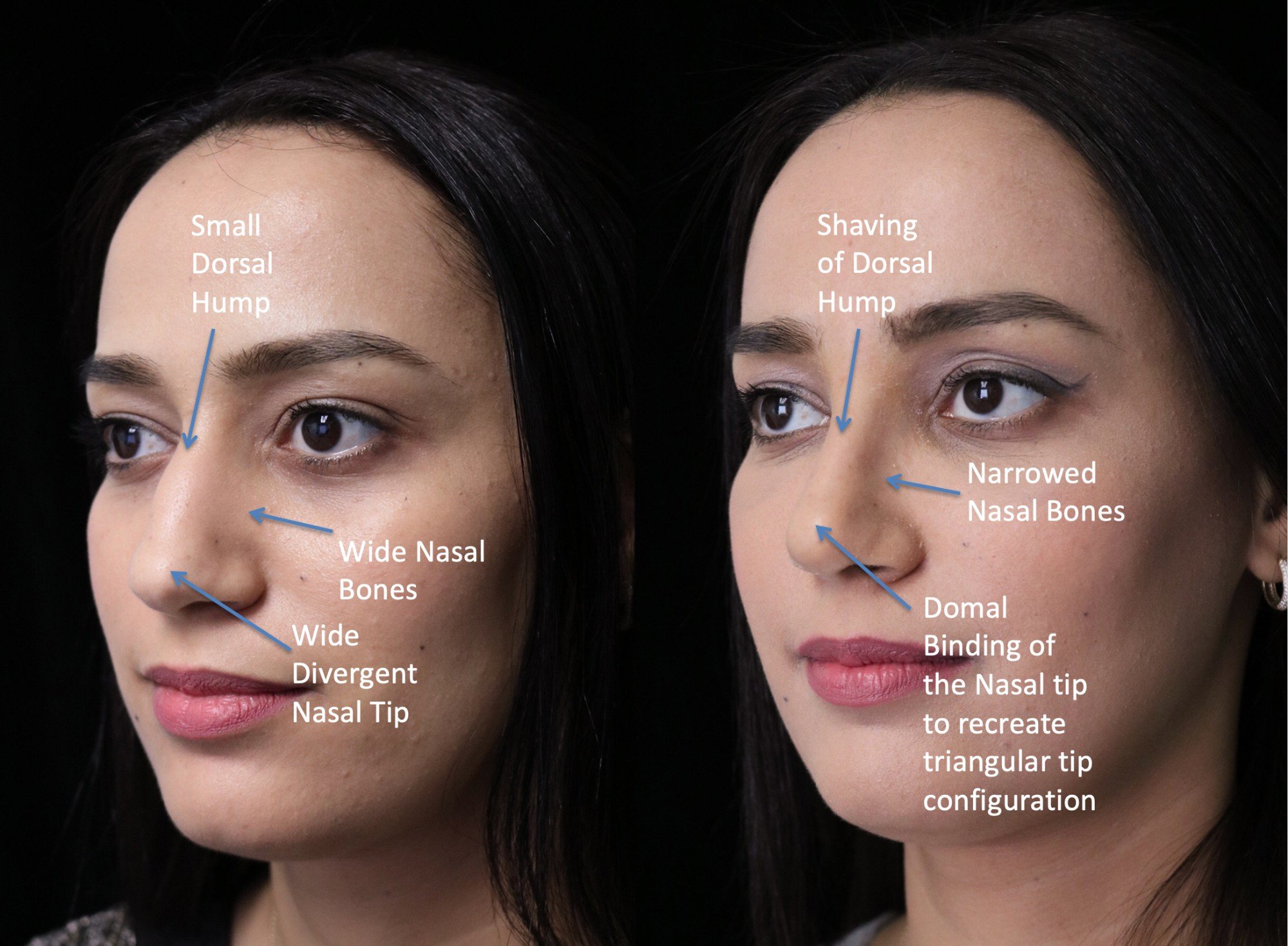 closed rhinoplasty before and after illustration of a woman with small dorsal hump