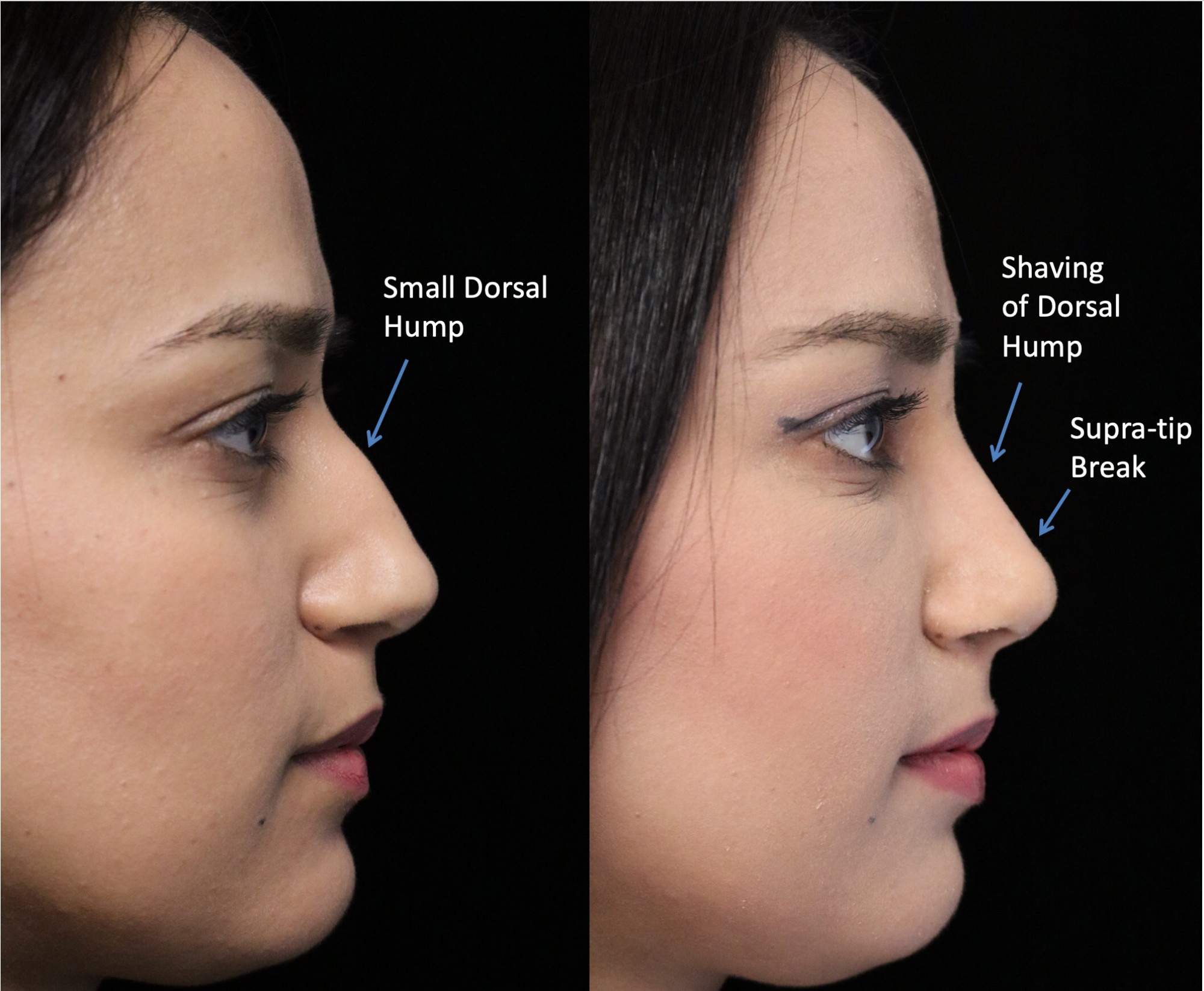 closed rhinoplasty before and after illustration of a woman with small dorsal hump