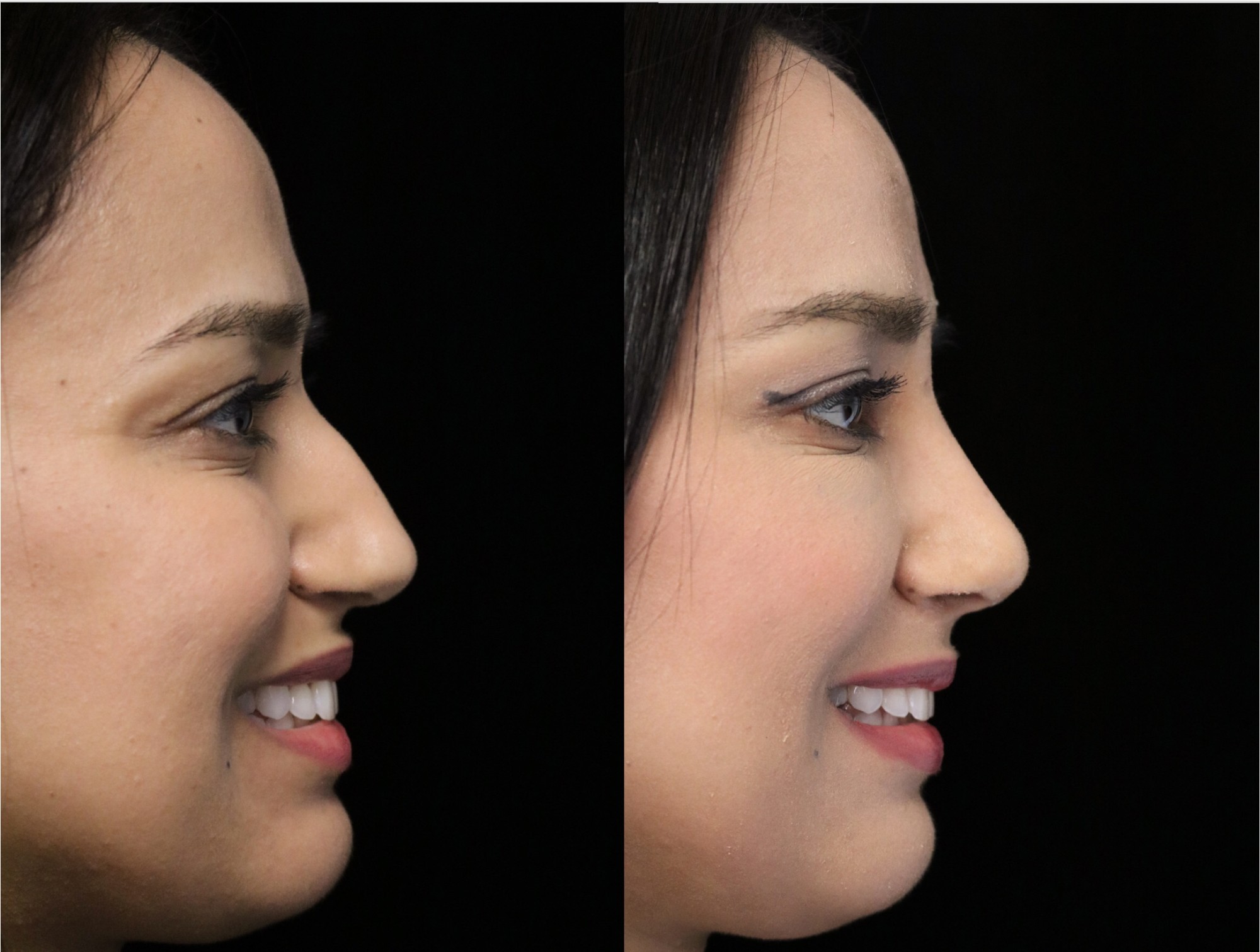 closed rhinoplasty before and after illustration of a woman with small dorsal hump