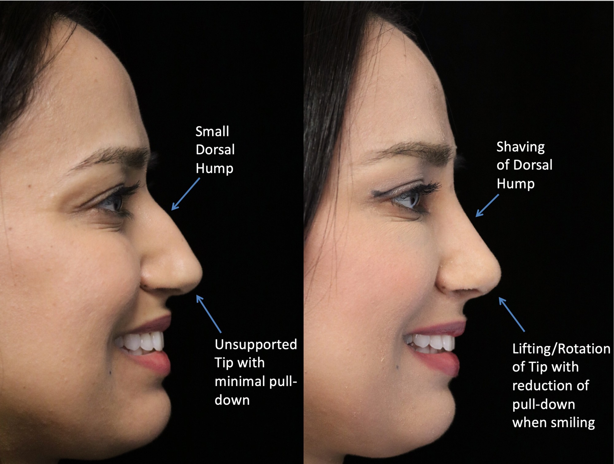 closed rhinoplasty before and after illustration of a woman with small dorsal hump