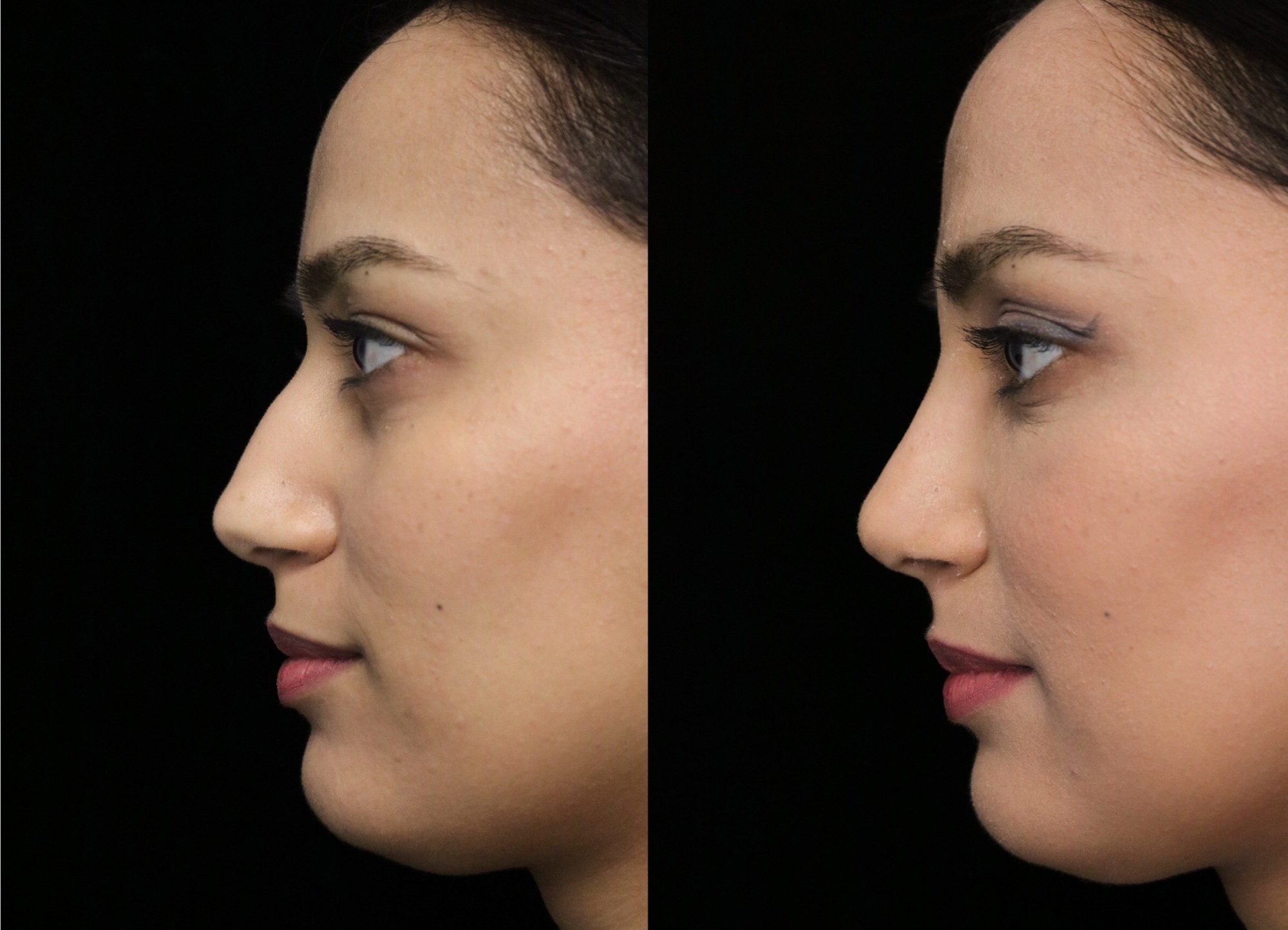 closed rhinoplasty before and after illustration of a woman with small dorsal hump