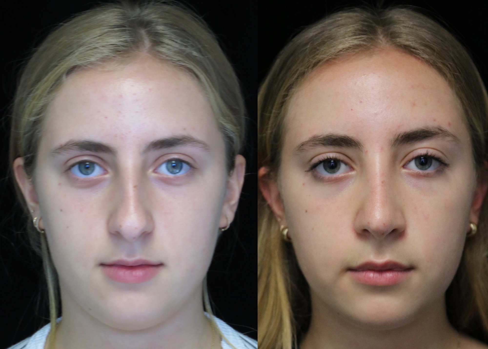 nose job before and after of a female with crooked nose