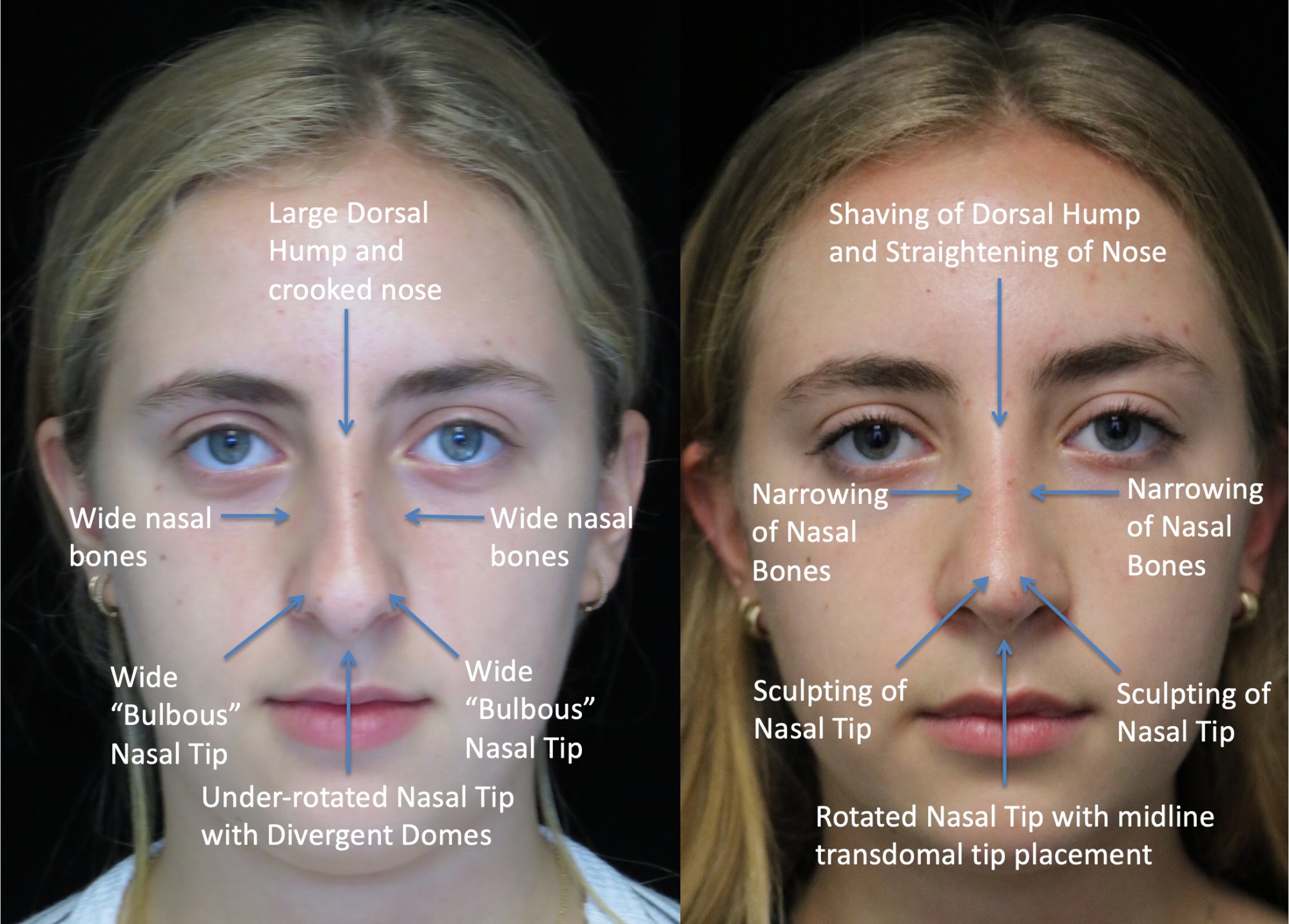 nose job before and after of a female with crooked nose