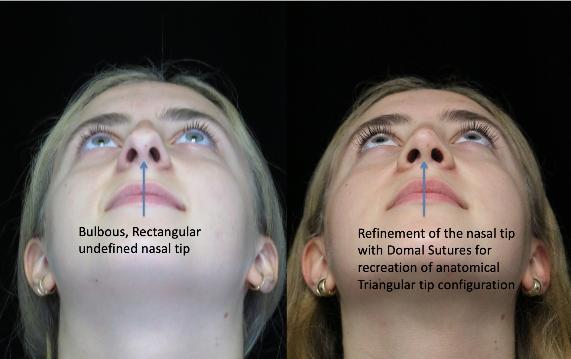 nose job before and after of a female with crooked nose
