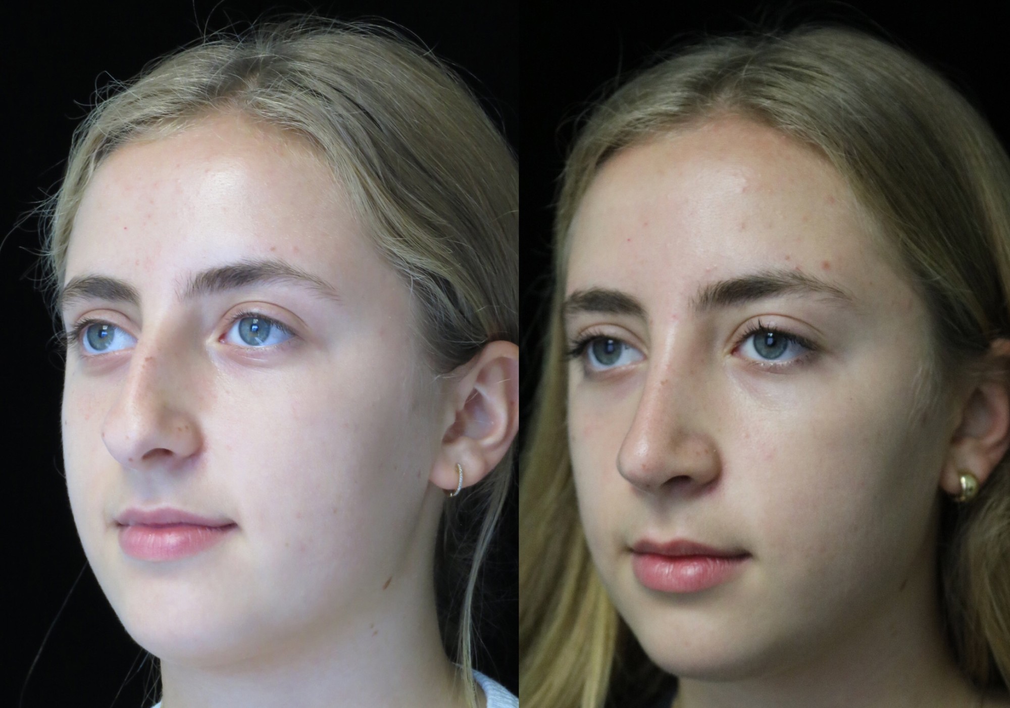 nose job before and after of a female with crooked nose