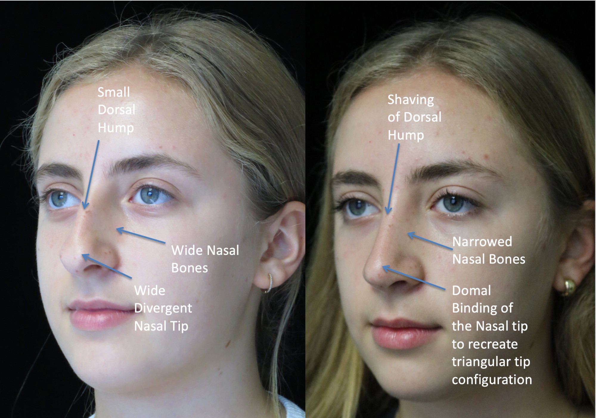 nose job before and after of a female with crooked nose