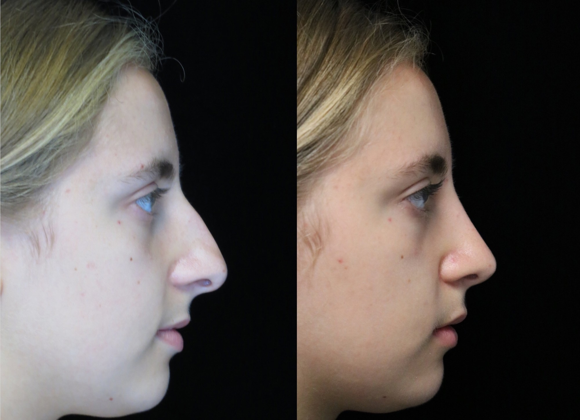 nose job before and after of a female with crooked nose