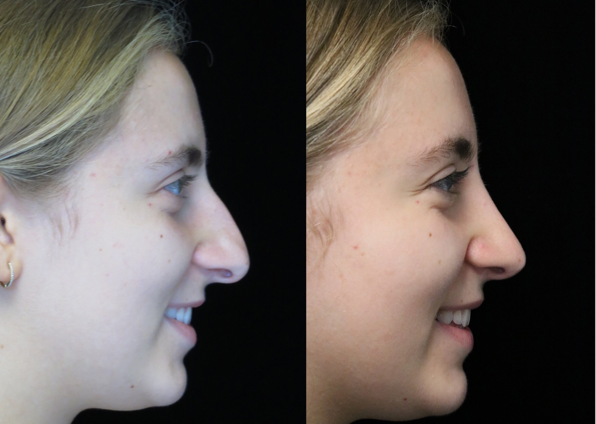 nose job before and after of a female with crooked nose