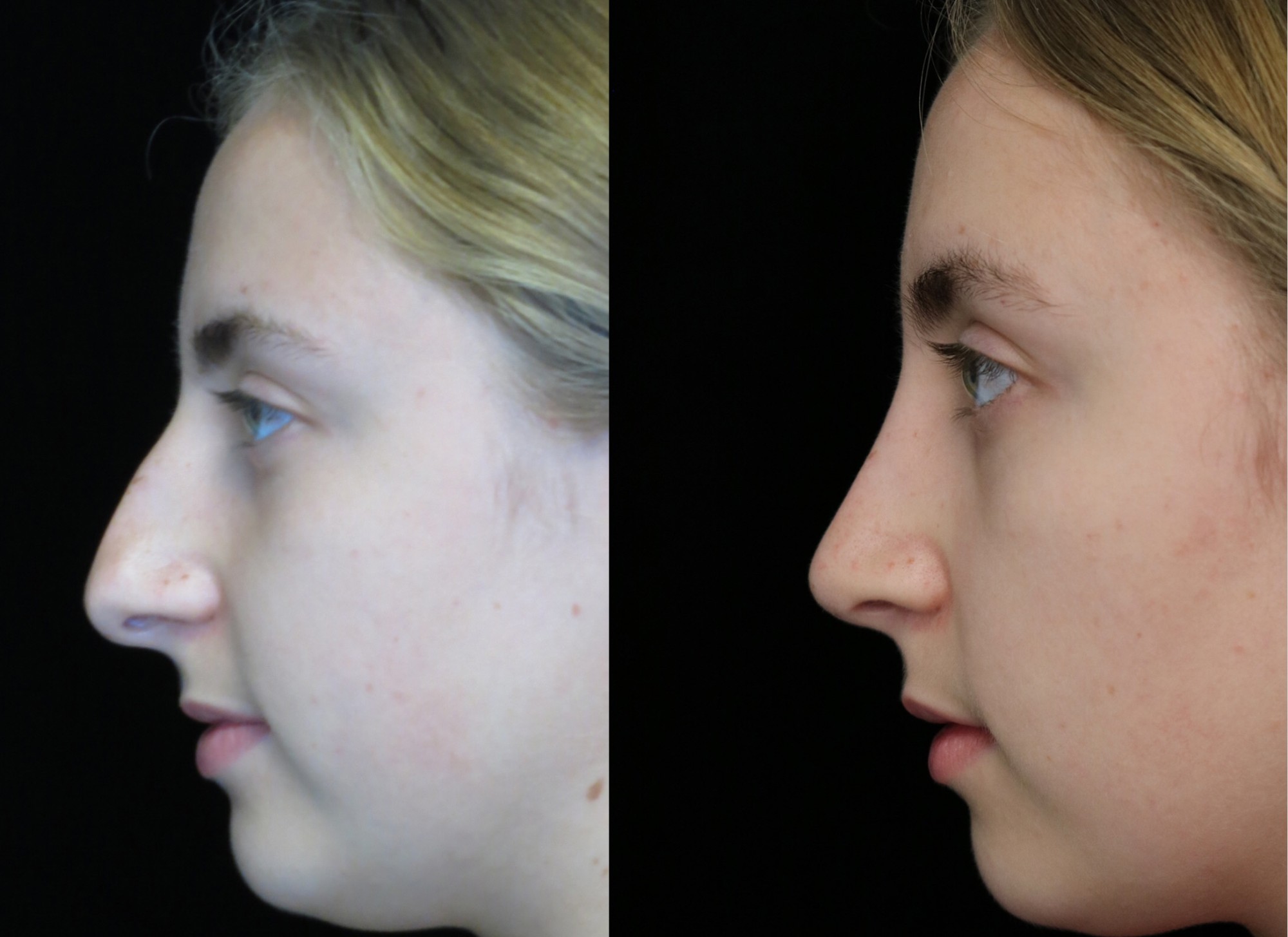nose job before and after of a female with crooked nose