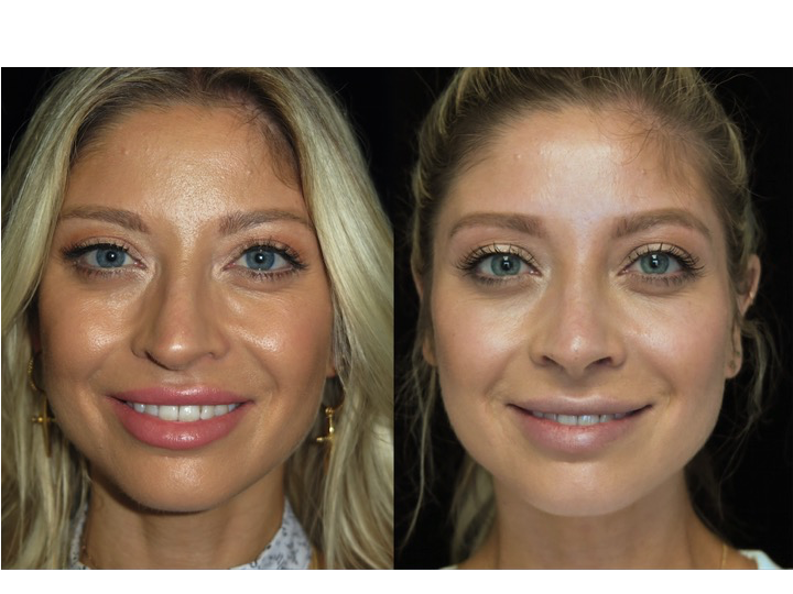 Illustration of a female patient with droopy nose tip who underwent a closed Scarless Nose® job tip refinement