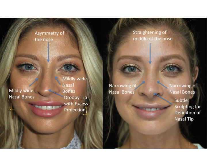 Illustration of a female patient with droopy nose tip who underwent a closed Scarless Nose® job tip refinement