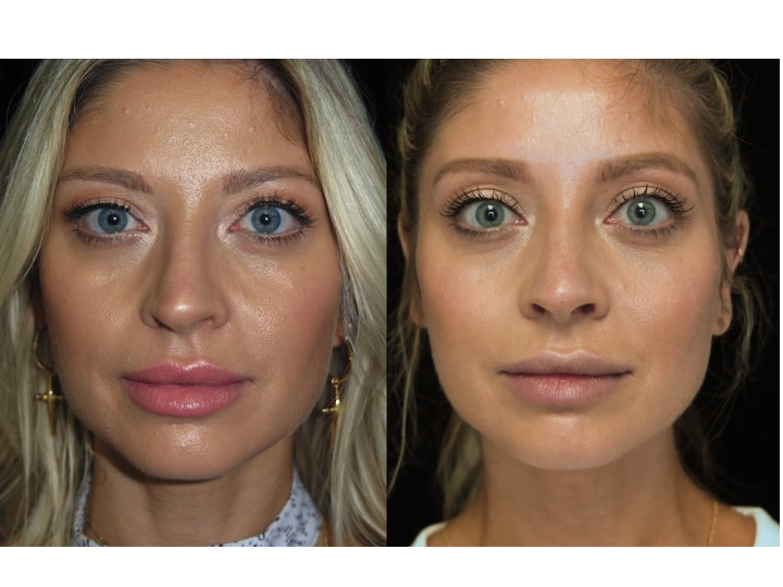 Illustration of a female patient with droopy nose tip who underwent a closed rhinoplasty tip refinement