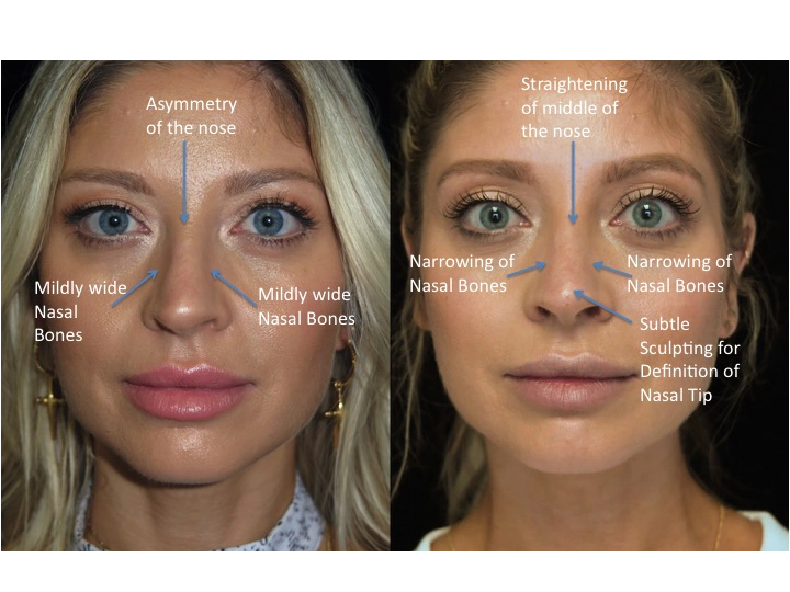 Illustration of a female patient with droopy nose tip who underwent a closed rhinoplasty tip refinement