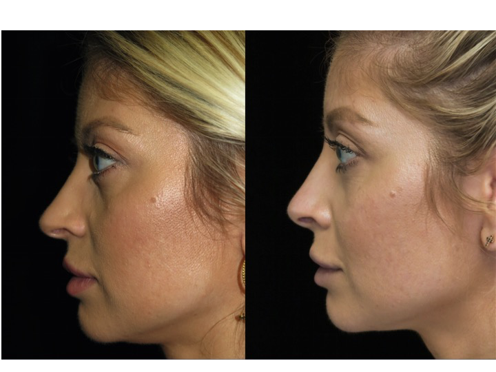 Illustration of a female patient with droopy nose tip who underwent a closed rhinoplasty tip refinement