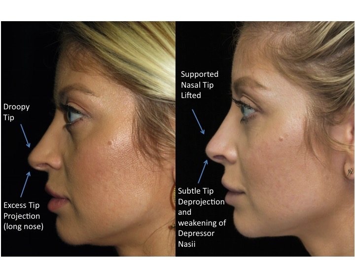 Illustration of a female patient with droopy nose tip who underwent a closed rhinoplasty tip refinement