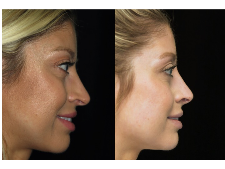 Illustration of a female patient with droopy nose tip who underwent a closed rhinoplasty tip refinement