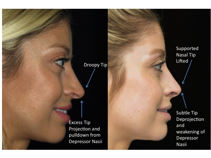 Illustration of a female patient with droopy nose tip who underwent a closed rhinoplasty tip refinement