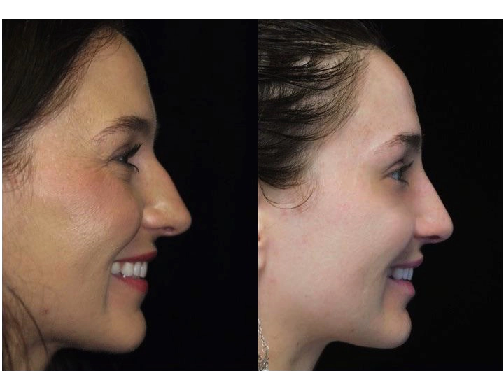 Nose job before and after of a female with small dorsal hump