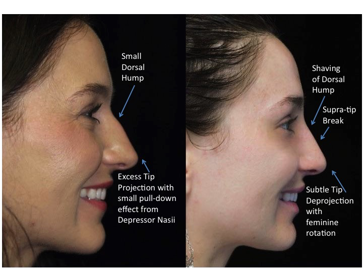 Nose job before and after of a female with small dorsal hump