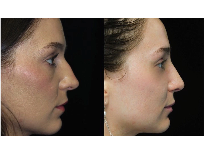 Nose job before and after of a female with small dorsal hump