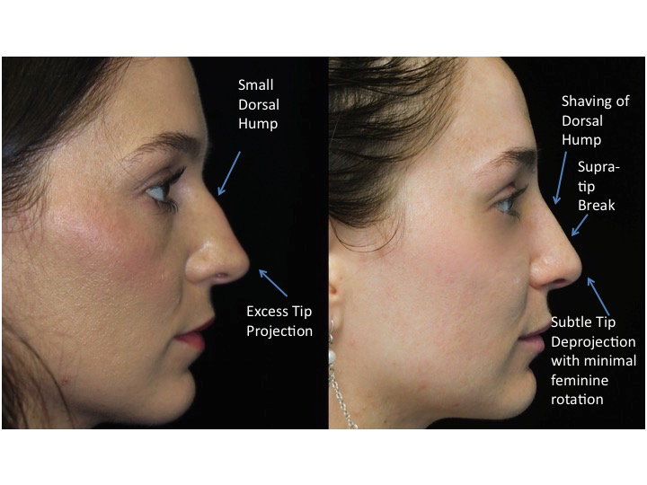 Nose job before and after of a female with small dorsal hump