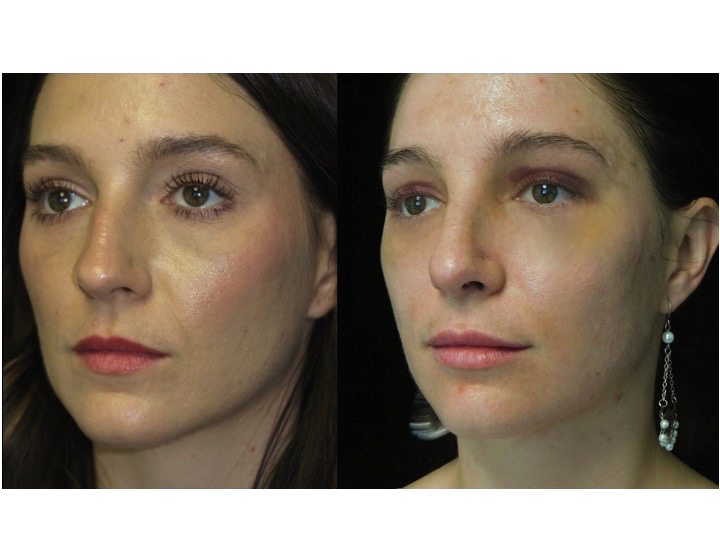 Nose job before and after of a female with small dorsal hump