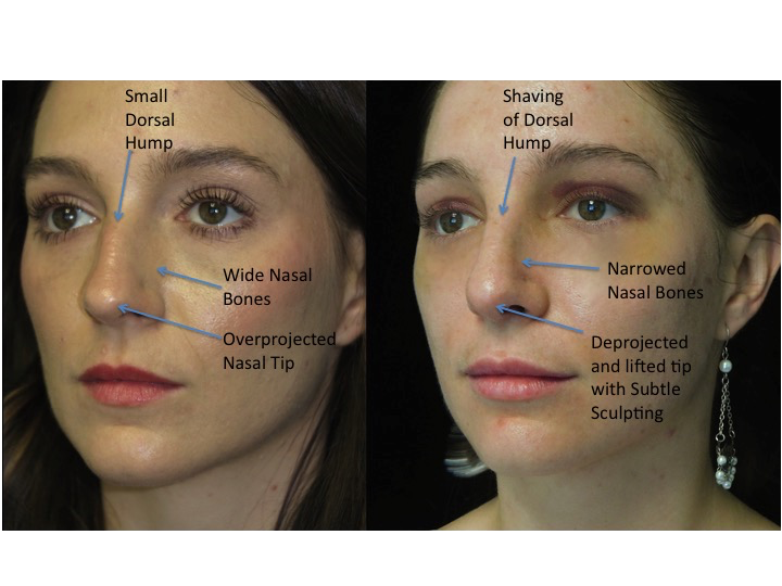 Nose job before and after of a female with small dorsal hump