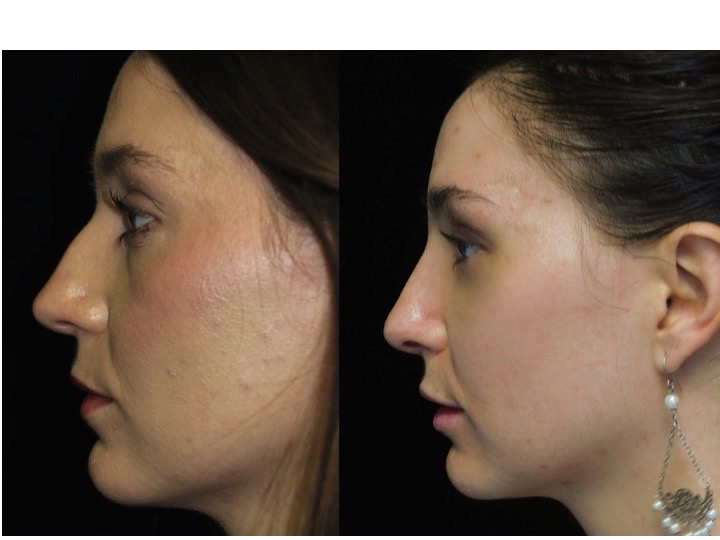 Nose job before and after of a female with small dorsal hump