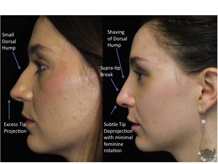 Nose job before and after of a female with small dorsal hump