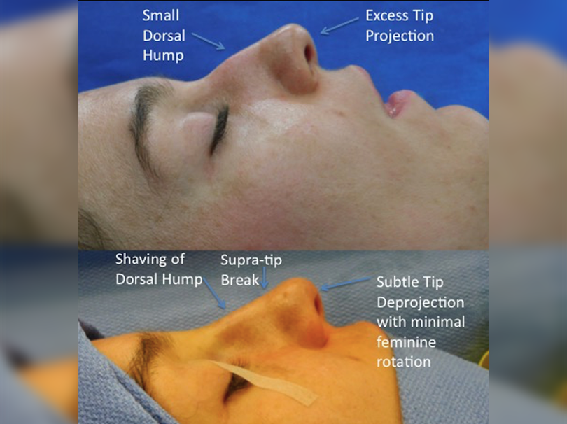 Rhinoplasty before and after photo of a female patient with excess tip projection