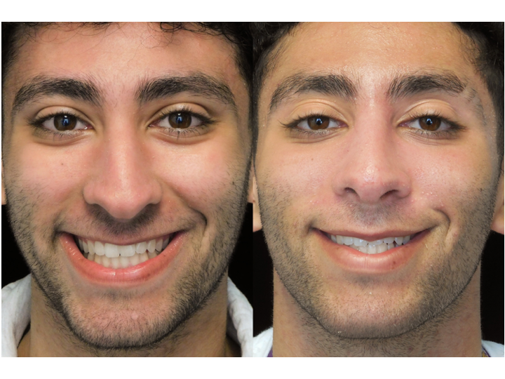 Illustration of a man with wide nasal bones who underwent a closed rhinoplasty