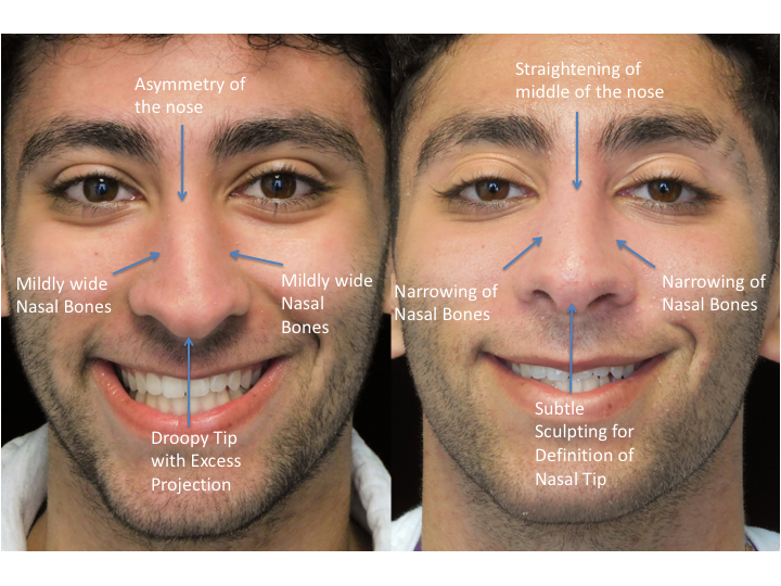 Illustration of a man with wide nasal bones who underwent a closed rhinoplasty