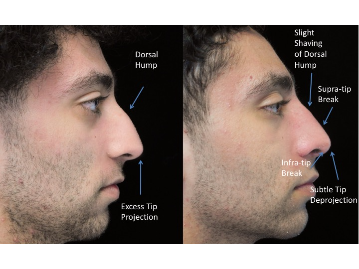 Illustration of a man with wide nasal bones who underwent a closed rhinoplasty