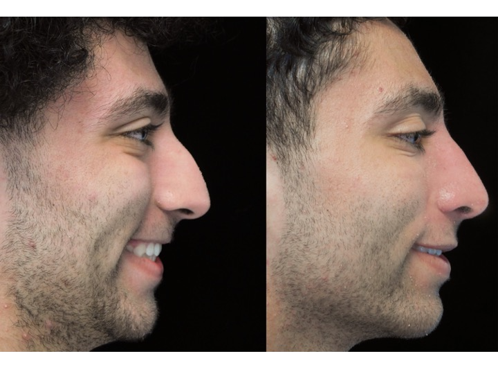 Illustration of a man with wide nasal bones who underwent a closed rhinoplasty