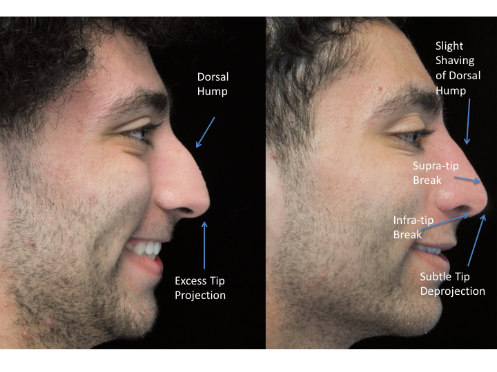 Illustration of a man with wide nasal bones who underwent a closed rhinoplasty