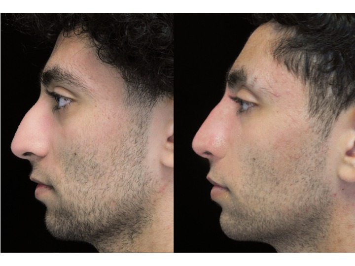 Illustration of a man with wide nasal bones who underwent a closed rhinoplasty