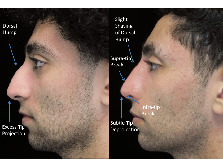 Illustration of a man with wide nasal bones who underwent a closed rhinoplasty